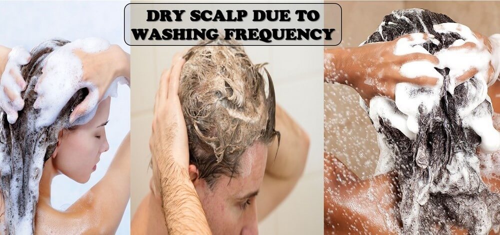 dry-scalp-treatment-at-home-4